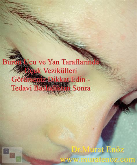 Ophthalmic Herpes Virus Infection and Hutchinson Sign