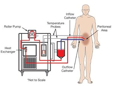 Image result for HIPEC Machine
