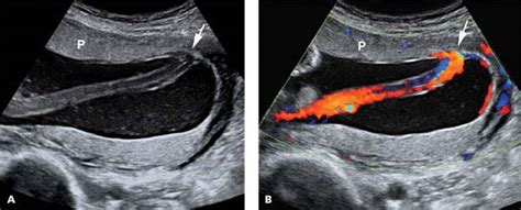 Bildergebnis für velamentous umbilical cord ultrasound
