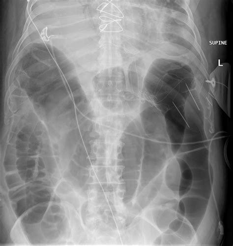 Radiopaedia case Large bowel obstruction from incarcerated inguinal ...