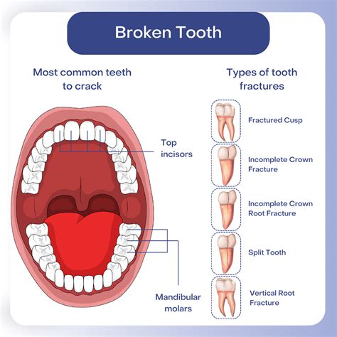Image result for Broken Tooth