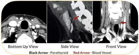 4D Parathyroid CT Scan - parathyroid