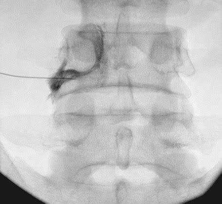 Image result for Fluoro Spinal Injection