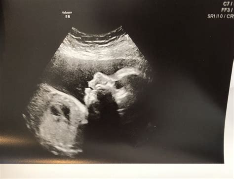 28 Weeks Ultrasound
