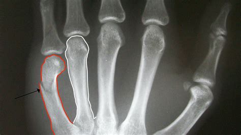 Xrays Of Fractures