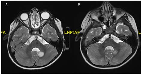 Pediatric and Adult Low-Grade Gliomas: Where Do the Differences Lie?