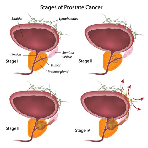 Resultado de imagen de prostate+cancer+stages
