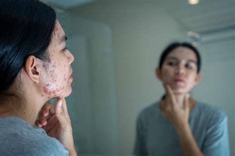 Fact Check: Can yam cream treat hormonal imbalance naturally?