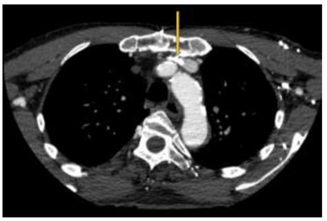Syndrome Sinistre: Left Brachiocephalic Vein Compression and its ...