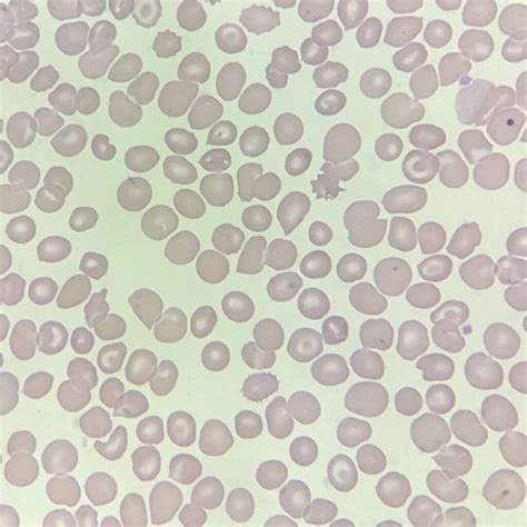 Target Cells: Appearance & Clinical Significance - MedLabBuddy