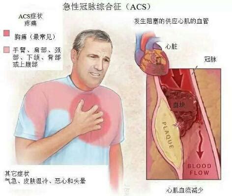 什么是心脏急性冠脉综合征