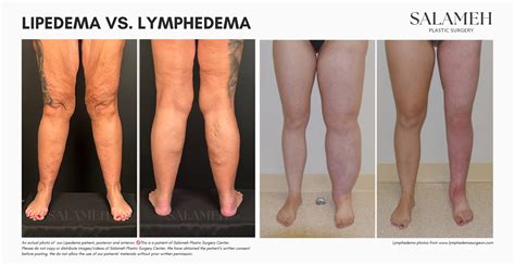 Lipedema vs Lymphedema: Key Differences You Should Know