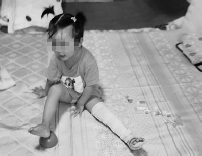 女童左腿和锁骨骨折 竟然是幼儿园煮饭阿姨干的！-新闻中心-温州网