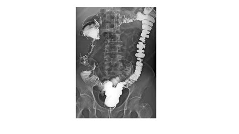 Small bowel follow through - barium studies .pptx