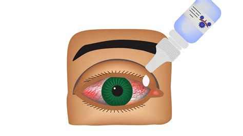 Home Remedies for Pink Eye & When to See a Doctor