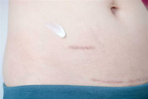 Using cream to care for scars after appendix surgery and postpartum surgical wounds 32484567 ...