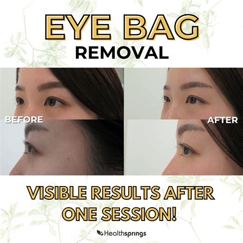 What Causes Eye Bags When Smiling at Charles Zeigler blog