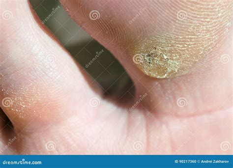 Plantar Wart on Big Toe. Visible Black Dots Warts Stock Photo - Image of infection, physical ...