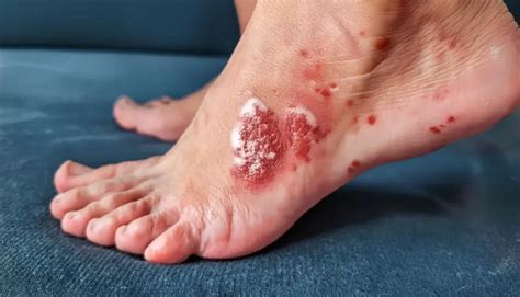 Can You Prevent Cellulitis? Best Skin Care Tips for Healthy Skin