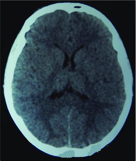 Image result for Normal Brain CT Scan