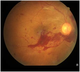 Department of Ophthalmology - Chettinad Academy