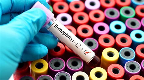 चोट लगने पर खून का बंद नहीं होना हो सकता है जानलेवा, जानिए क्या है ...