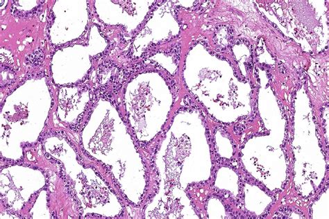 Clear Cell Ovarian Cancer