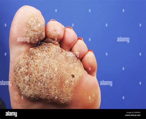 Plantar Warts High Resolution Stock Photography and Images - Alamy