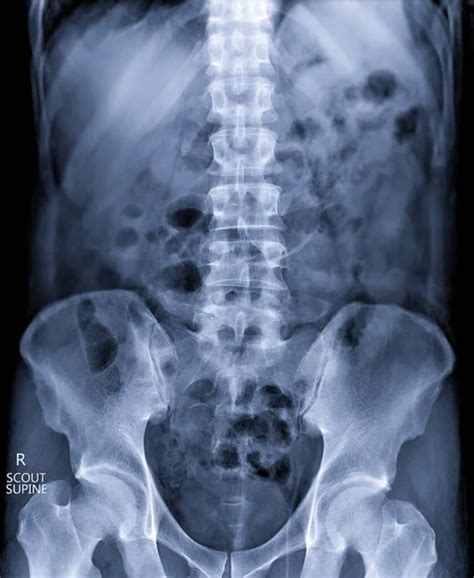 Image result for Contrast Pyelogram