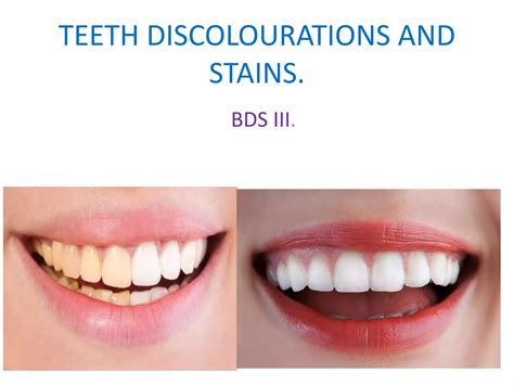 Teeth stains and discolorations | PPTX
