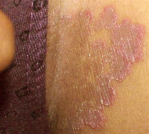 chlamydia rash on inner thigh female