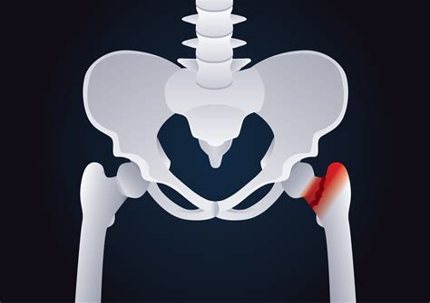 Stress Fracture of the Hip - Physioflow PT | Physical Therapy | Vancouver, WA