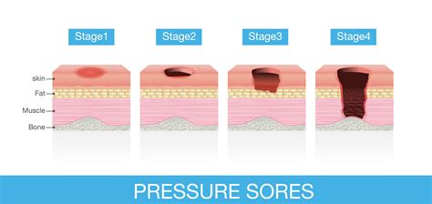 Pressure Ulcer Grades | Pressure ulcer, Soreness, Ulcers