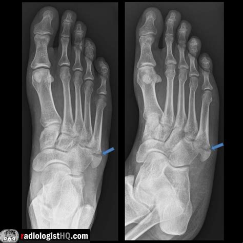 Jones Fracture Orthobullets