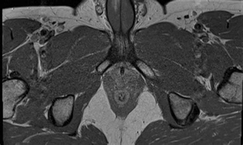 First Ever Recorded Case of Vertical Penile Fracture: BMJ