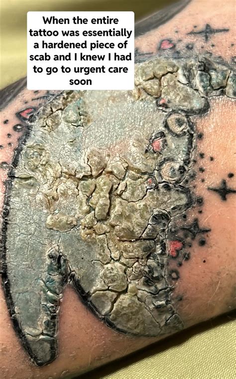 What do infected tattoos look like - Bronctattooaus.com