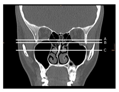 Radiological Markers of the Olfactory Cleft: Relations to Unilateral ...