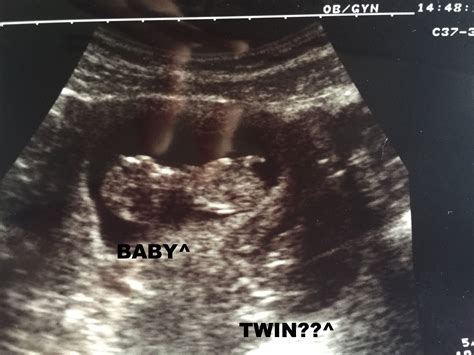 8 Week Ultrasound Twins