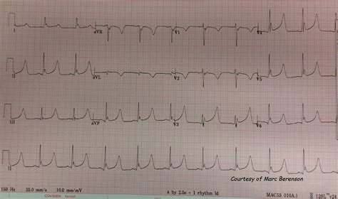 Osborn Waves | ECG Guru - Instructor Resources