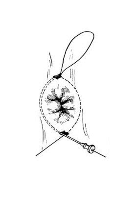 肛门环缩术过程图解-手术图解,_医学图库