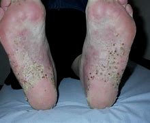 Image result for pustulosis