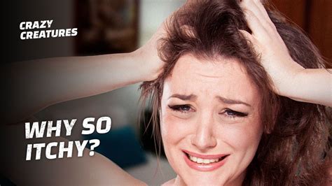 Scalp Parasites 的图像结果