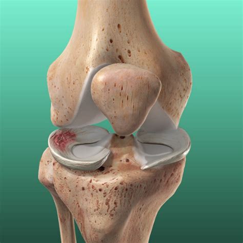 Knee Pain
