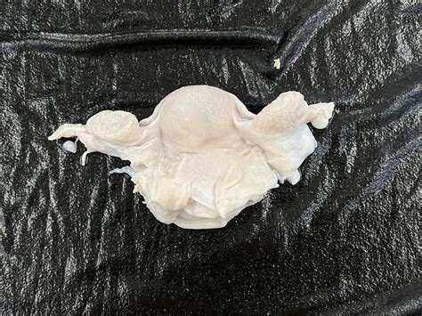 uterus with ovary | NAMO Medical Education & Research Institute