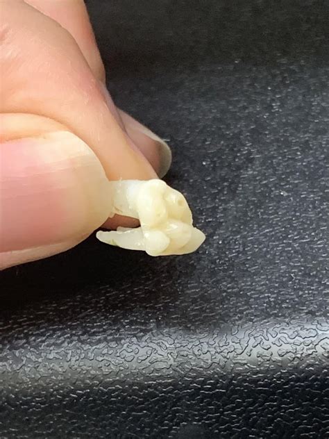 Image result for Abscessed Tooth Explosion