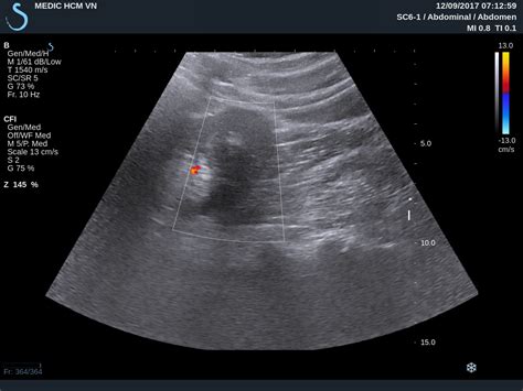 VIETNAMESE MEDIC ULTRASOUND: CASE 457: AML KIDNEY TUMOR, Dr PHAN THANH HẢI, Dr NGUYỄN HOÀNG ĐỨC ...