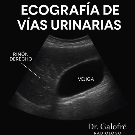 Ecografía de Vías Urinarias en Cartagena. Evaluación de riñones ...