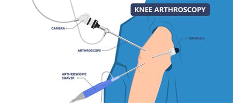 Knee Arthroscopy Cost in India - Factors Influencing Price