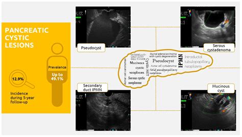 Real-Life Management of Pancreatic Cysts: Simplified Review of Current ...