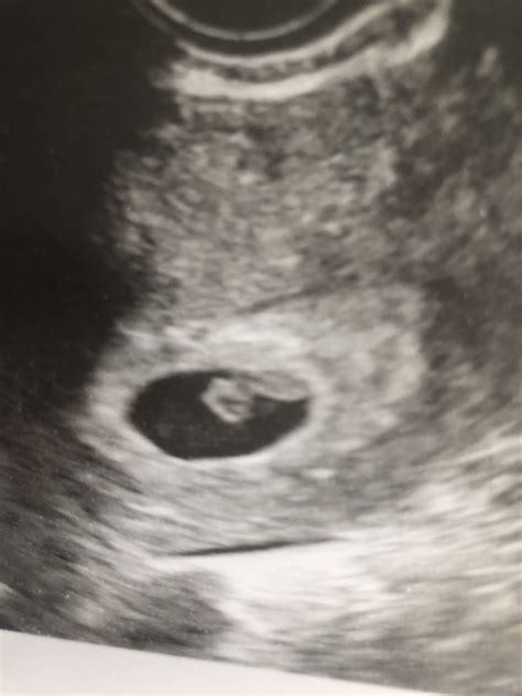 Ultrasound At 7 Weeks Pregnant